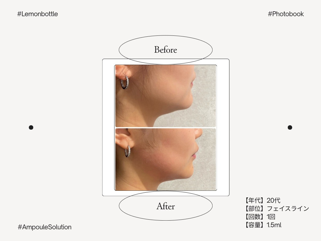 エステ版ダーマペン